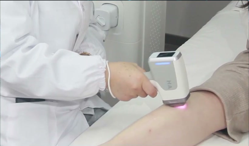 Cadru real din clip: aplicatorul laser diode în timpul tratamentului pe gambă